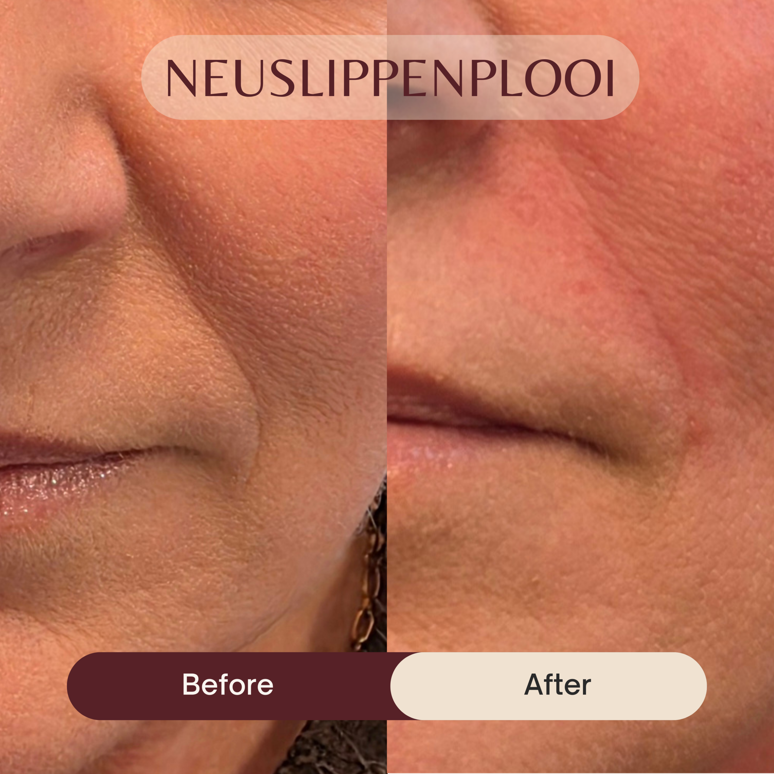 Before & After - nasolabiaal plooien en jukbeenderen (5)